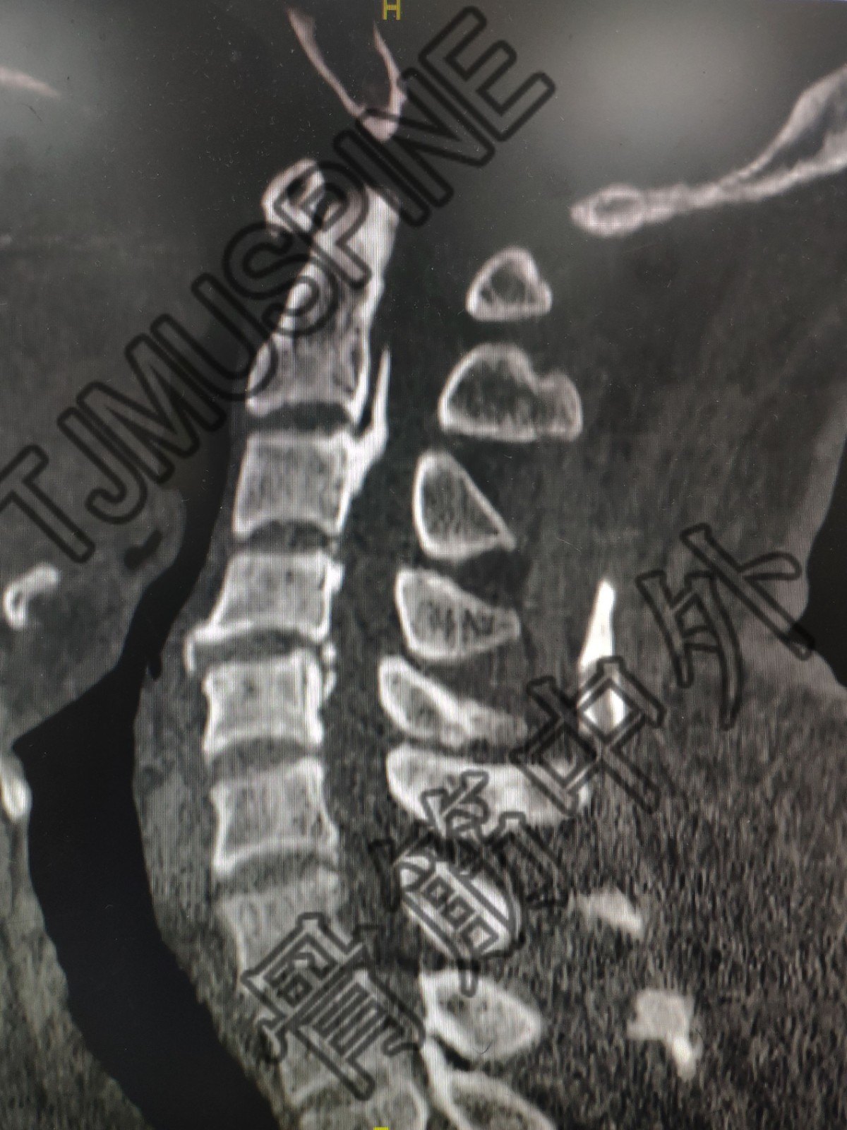 術前頸椎ct:骨化的後縱韌帶術前頸椎x線動力屈伸位術前頸椎x線平片正