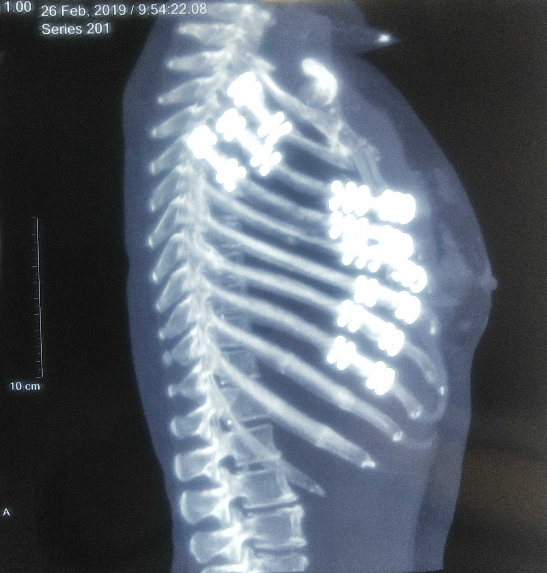 肋骨骨折手术没有对比就没有伤害 肋骨骨折手术没有对比就没有伤害