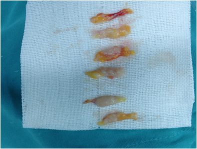 乳腺微创手术切除乳腺结节
