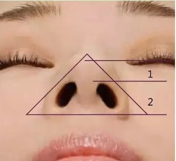 鼻整形师徒对话(109)鼻孔的形态——鼻整形塑形的难点三