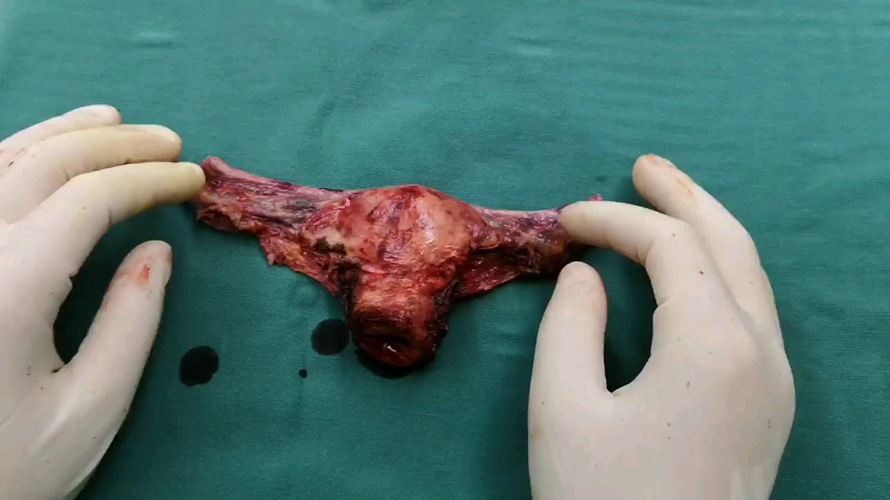 宫颈原位腺癌腹腔镜手术