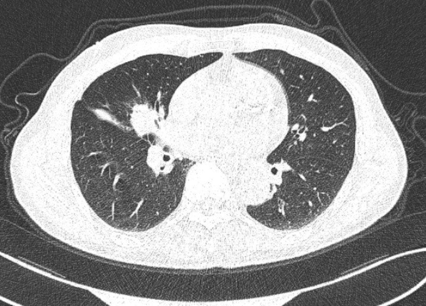 83歲肺癌,胸腔鏡治癒出院