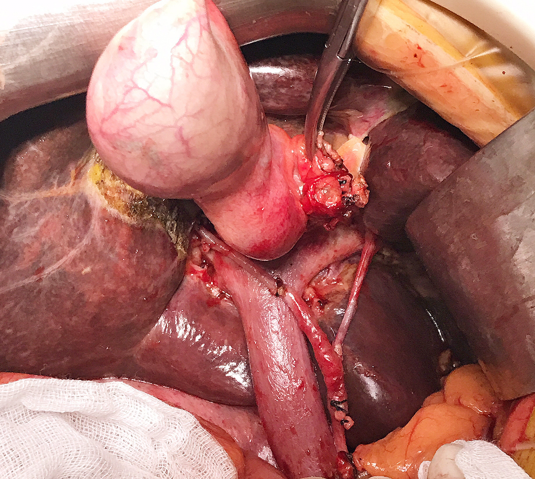 事实证明,天上不掉馅饼,胆管中上段的肿瘤,淋巴结估计已经有转移,万幸