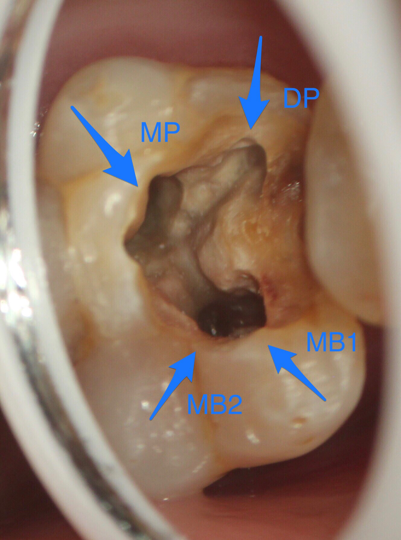 根管治疗的复杂性:上颌牙mb2根管两例