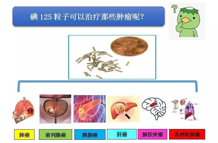 小身板大作用丨它就是癌症斗士"碘125粒子"!_治疗方法 - 好大夫在线