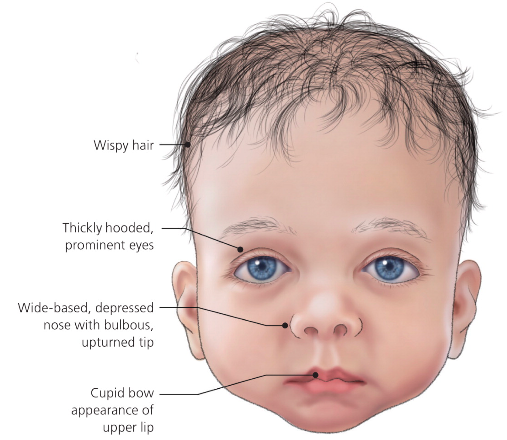 神经纤维瘤科普8i型神经纤维瘤病的非典型表现有哪些