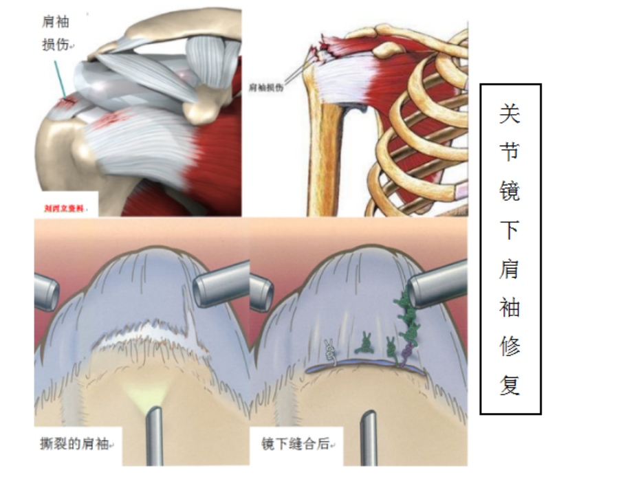 囊腫關節鏡技術關節外應用:ü踝關節疾病:距後三角骨,踝關節滑膜炎