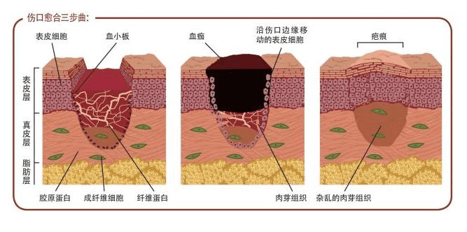 创伤愈合基本过程皮肤手术一般会涉及皮下组织层,所以伤口并不算浅呢.