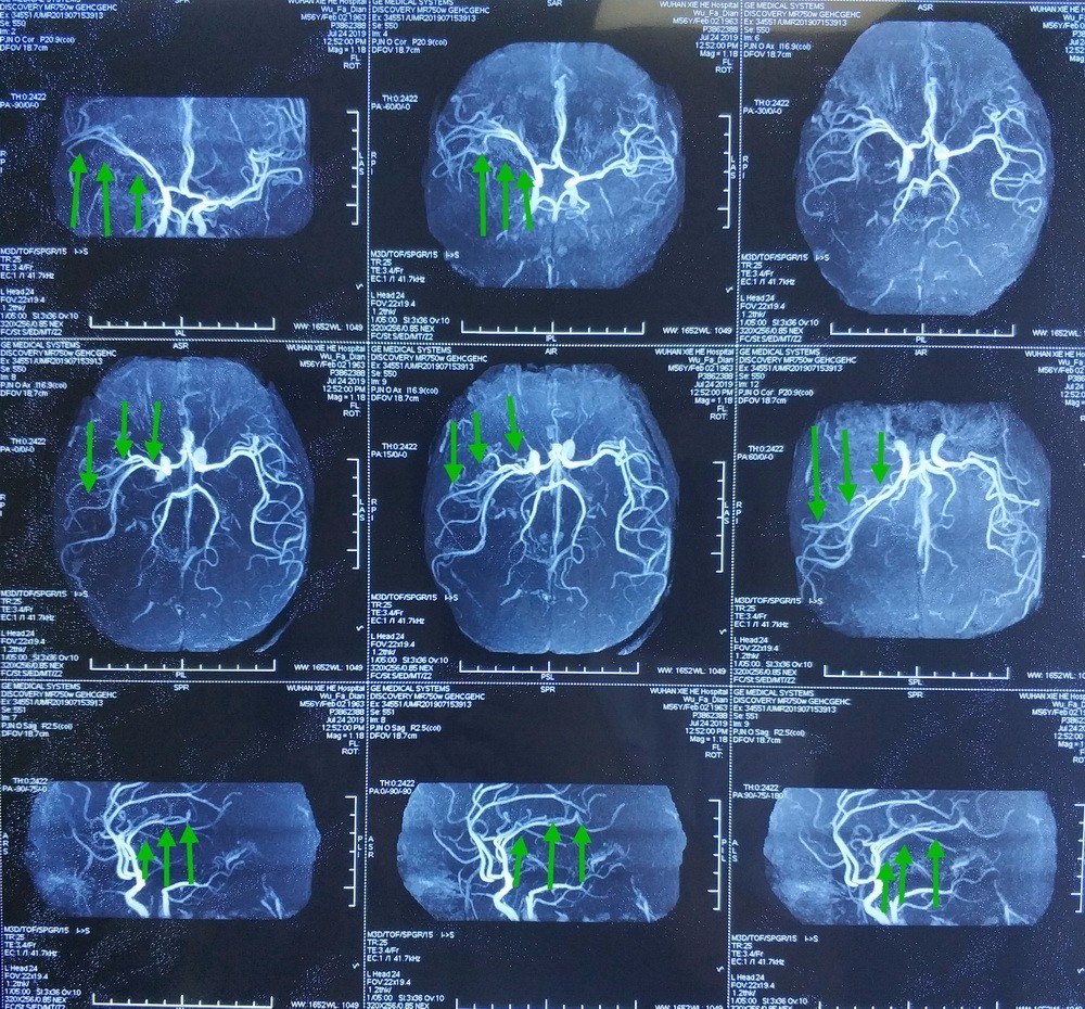 正常mra图像脑血管分段图片