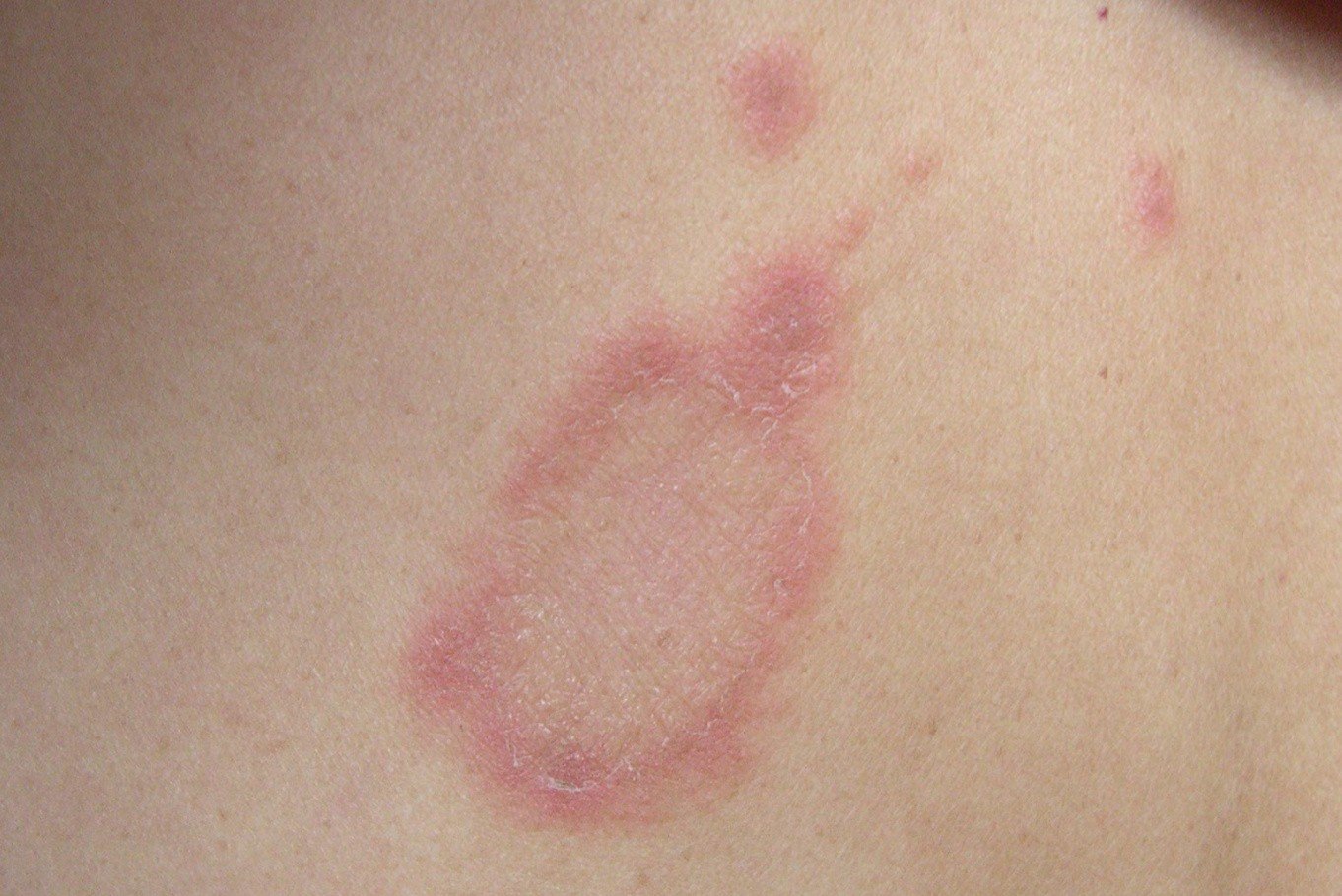 玫瑰糠疹的症状和图片图片