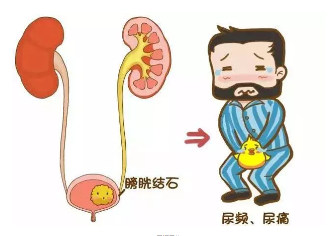 泌尿系结石_介绍_症状表现 - 好大夫在线