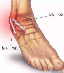 跟腓韧带损伤怎么办图片