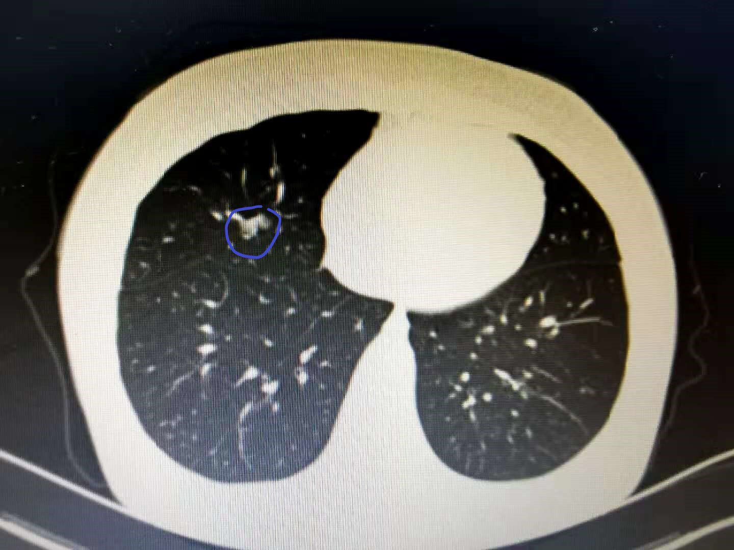 单个肺部结节肺部肿块怎么办