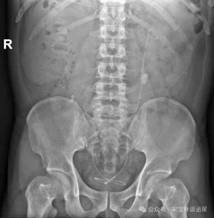 左肾积水怎么解决 woYBAGaJnwqAOAt1AADMIZ3OMGw594.png?_ms_=7e0d