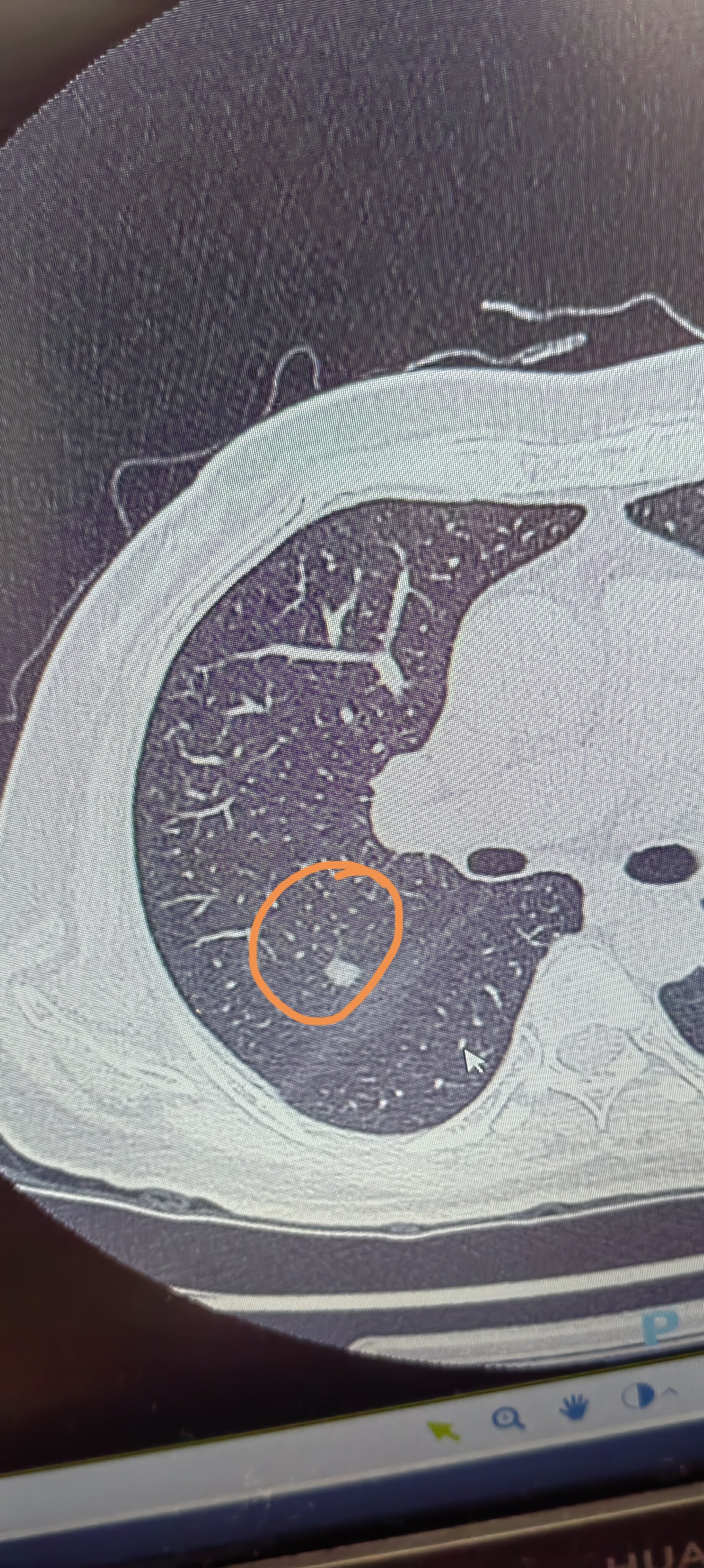 肺磨玻璃结术前胸部ct