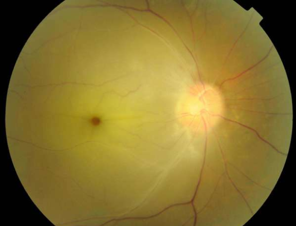 视网膜中央动脉栓塞典型病例 - 好大夫在线