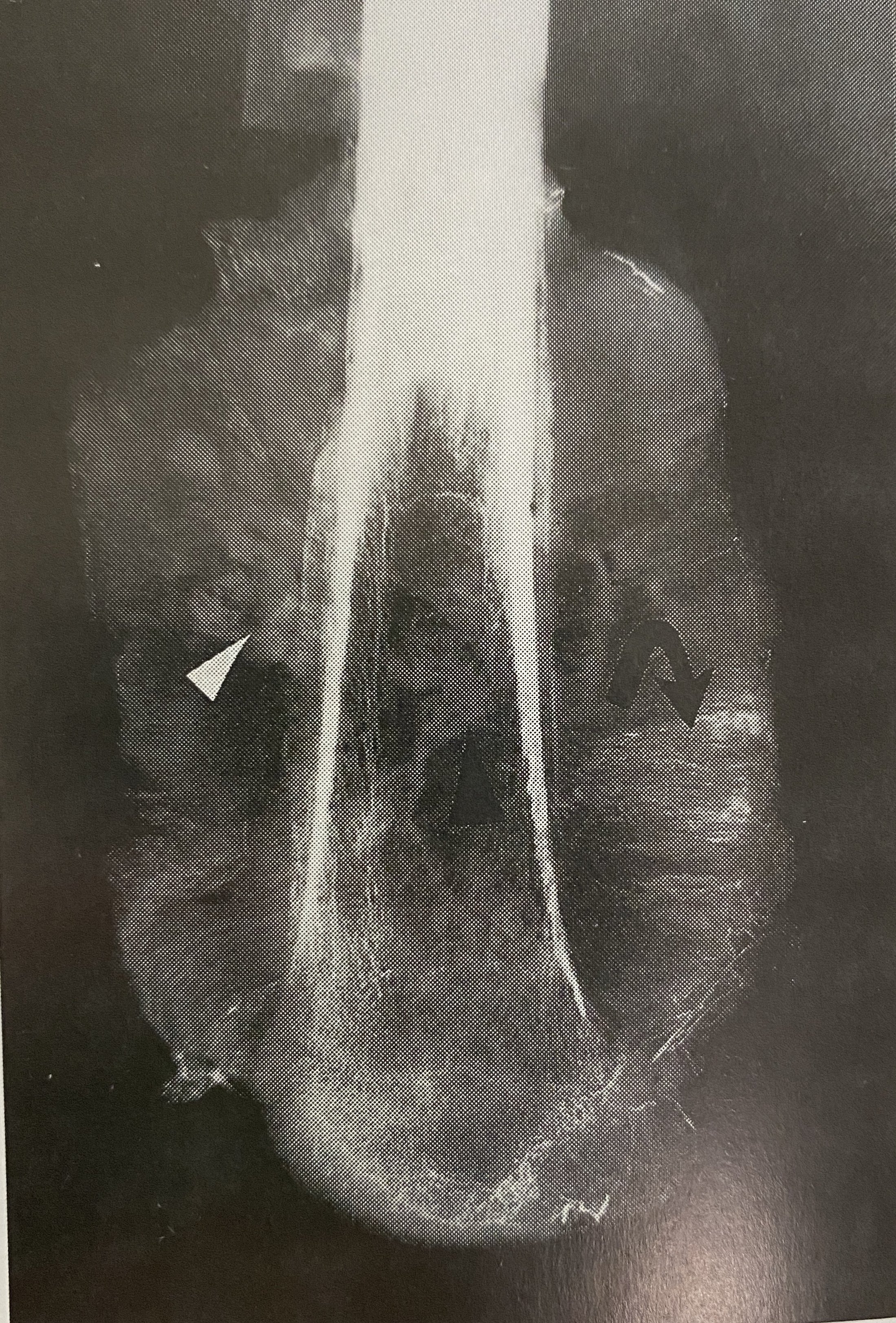 骨肉瘤象牙质样瘤骨x线平片:股骨下段髓腔内有高密度象牙质样瘤骨