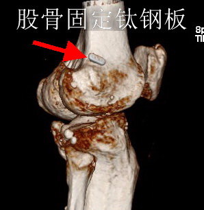 Right Hip Joint CT 3D.-VRT Range-.Se602.Img9.jpg