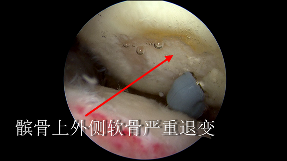 x髌骨上外侧软骨严重退变.png