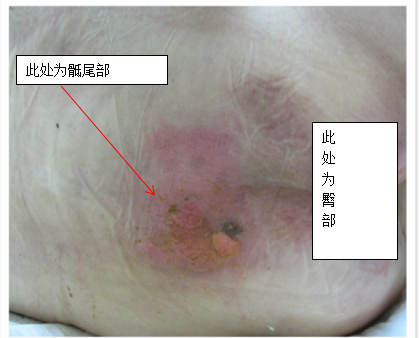 压疮小讲堂 一 褥疮 褥疮 压疮小讲堂 一 褥疮 褥疮