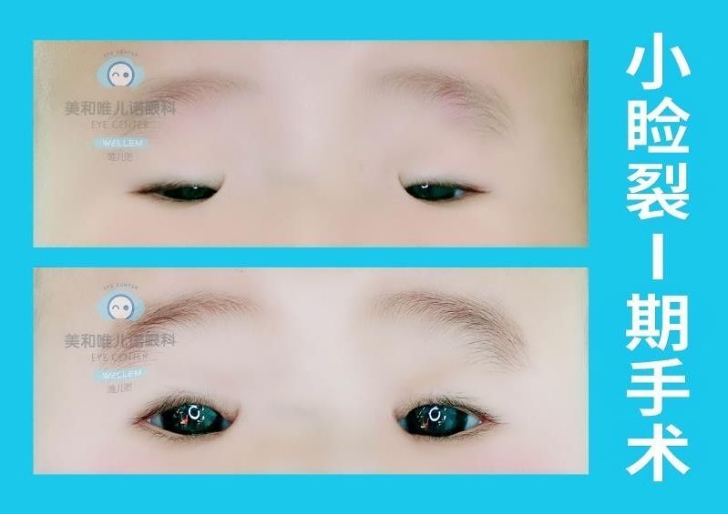 小睑裂综合症手术前后照片(二)_小睑裂 - 好大夫在线