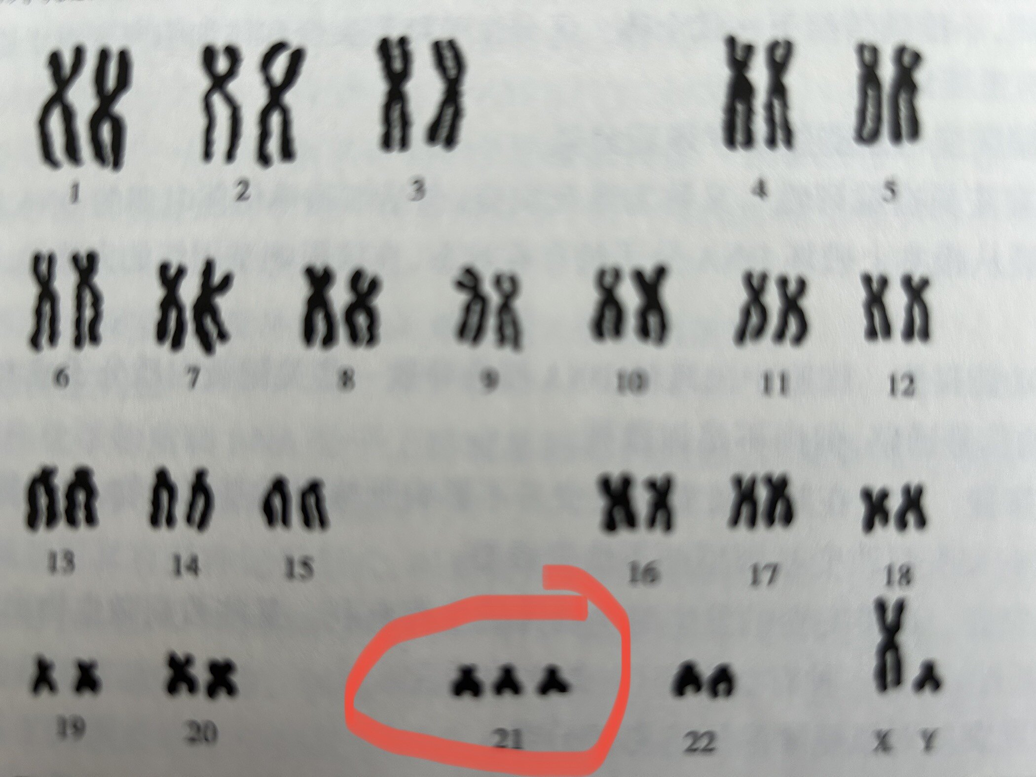 非整倍体变异常见的两种精神发育迟滞疾病