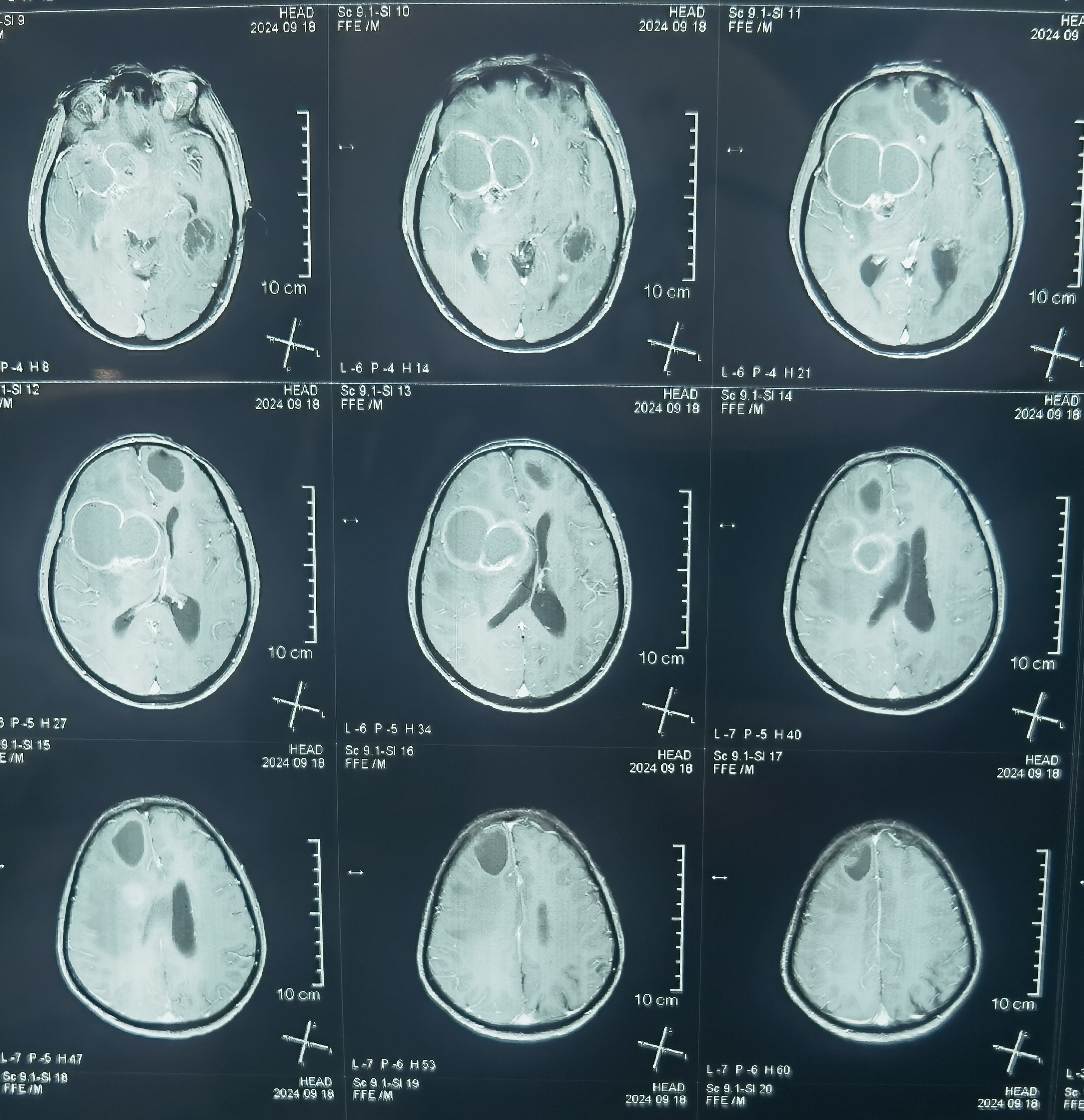 哪些脑转移瘤可以手术治疗?