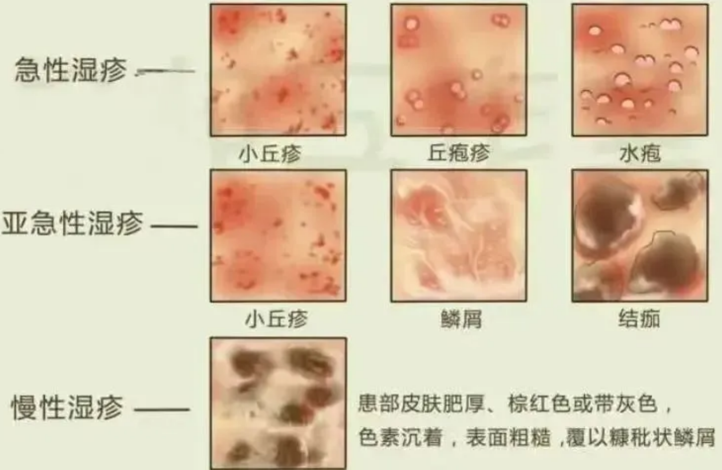 外生殖器皮肤病 一篇文章了解阴囊湿疹,看完再也不焦虑!