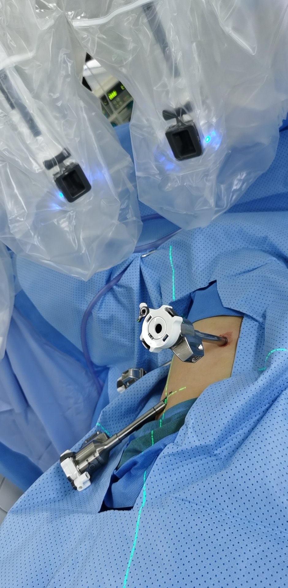 手术切口选择,腋中线第8肋间观察口,腋前线第5肋间,腋后线第8肋间操作