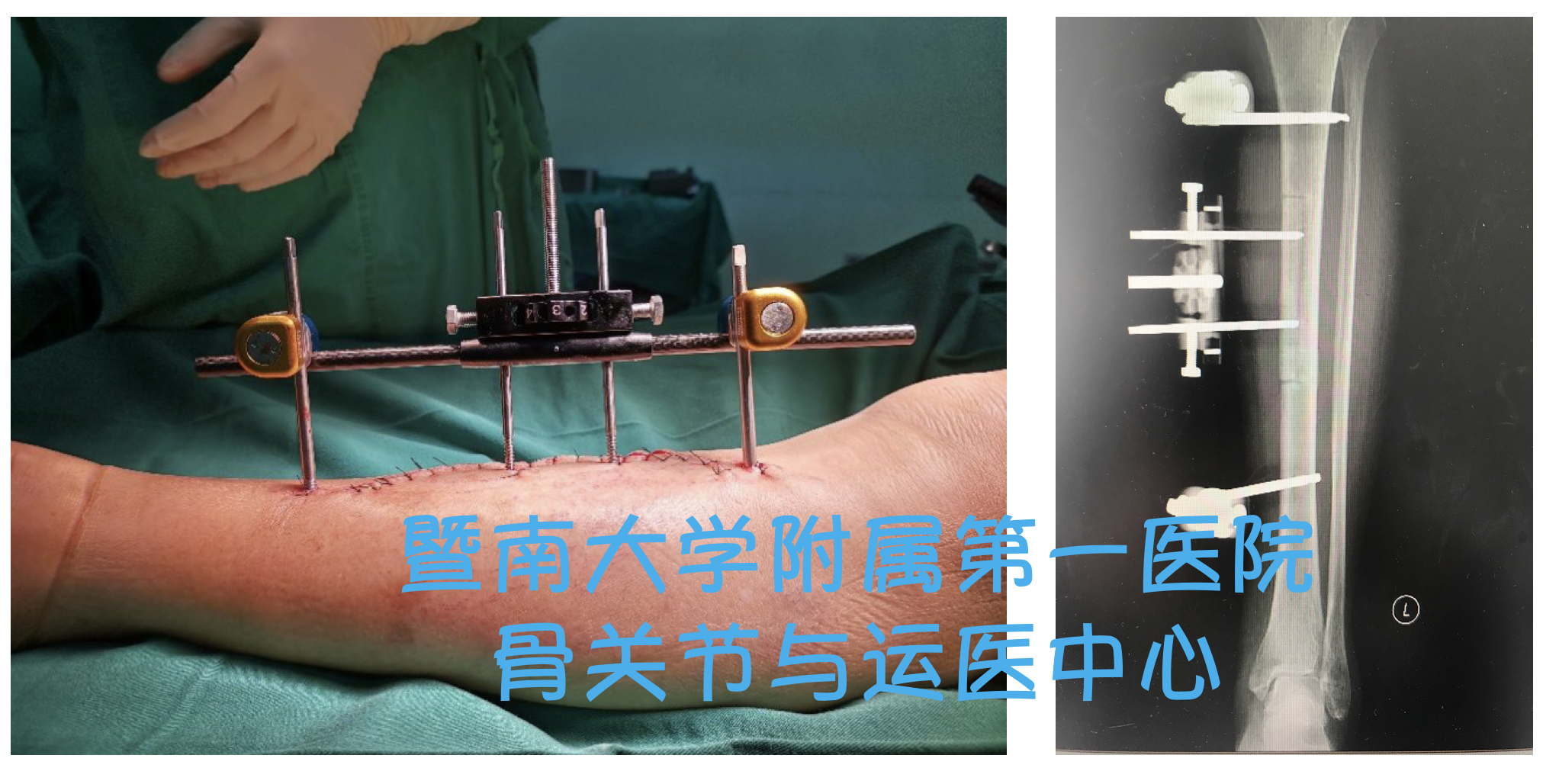 手术安装骨搬运支架,现在更微创,术程约半小时搬运1周后,足背皮温开始