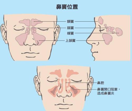 慢性鼻窦炎的症状 www.haodf.com
