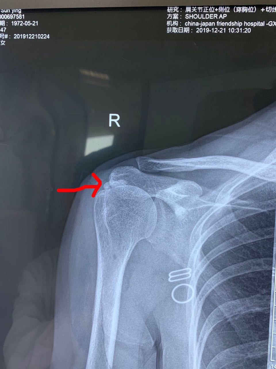 肩周炎x线平片报告图片