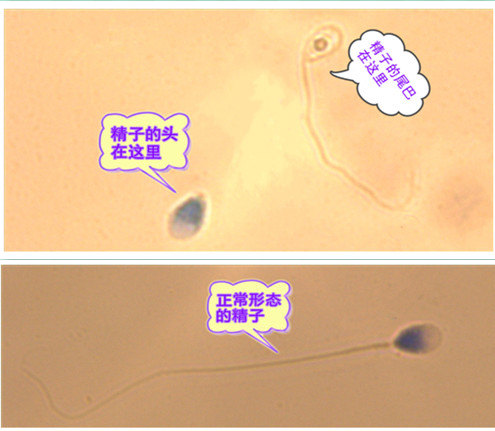 畸形精子症之无头精子_男性不育- 好大夫在线