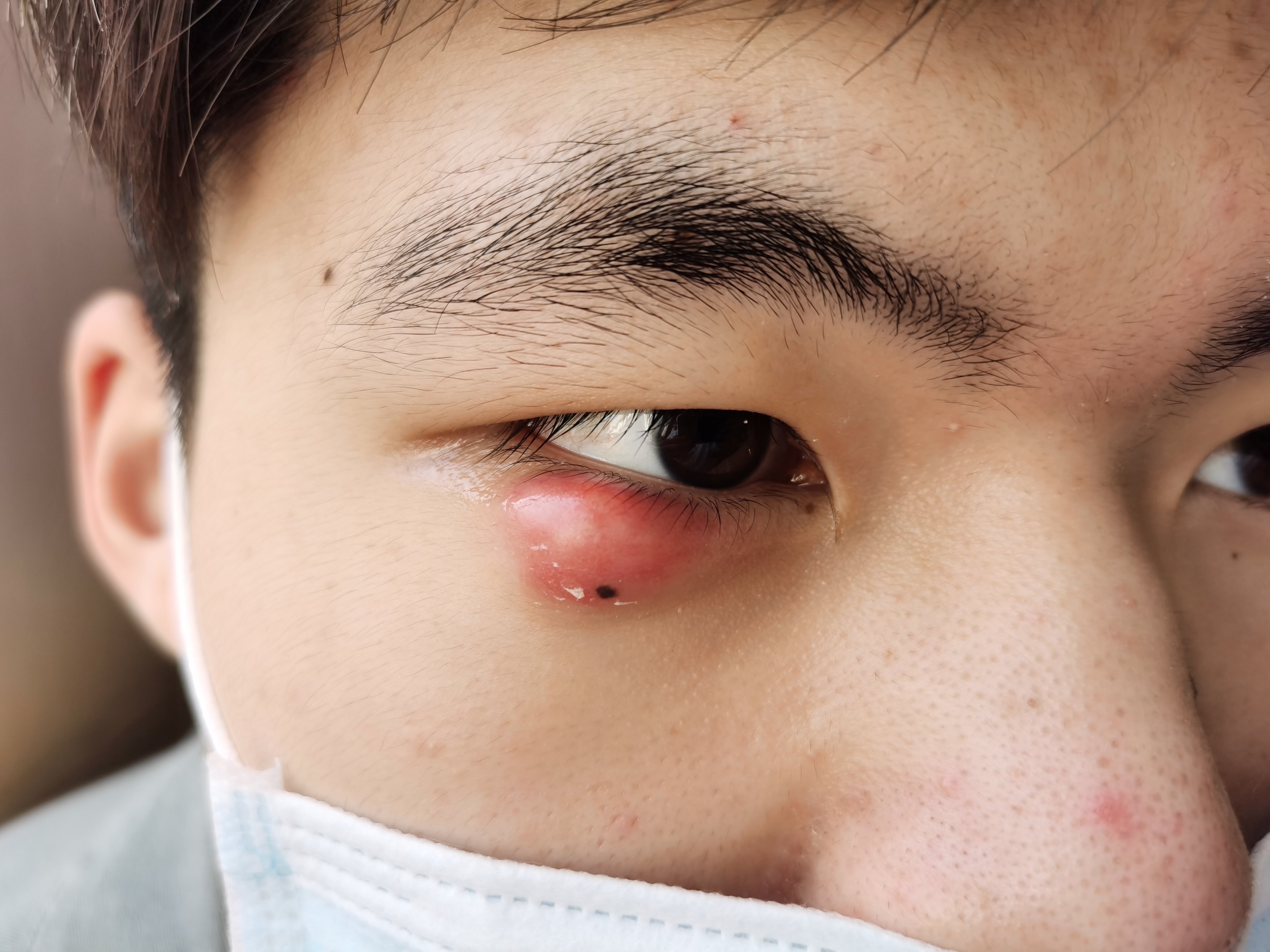 睑腺炎(俗称:麦粒肿,中医名:针眼)的个人经验治疗
