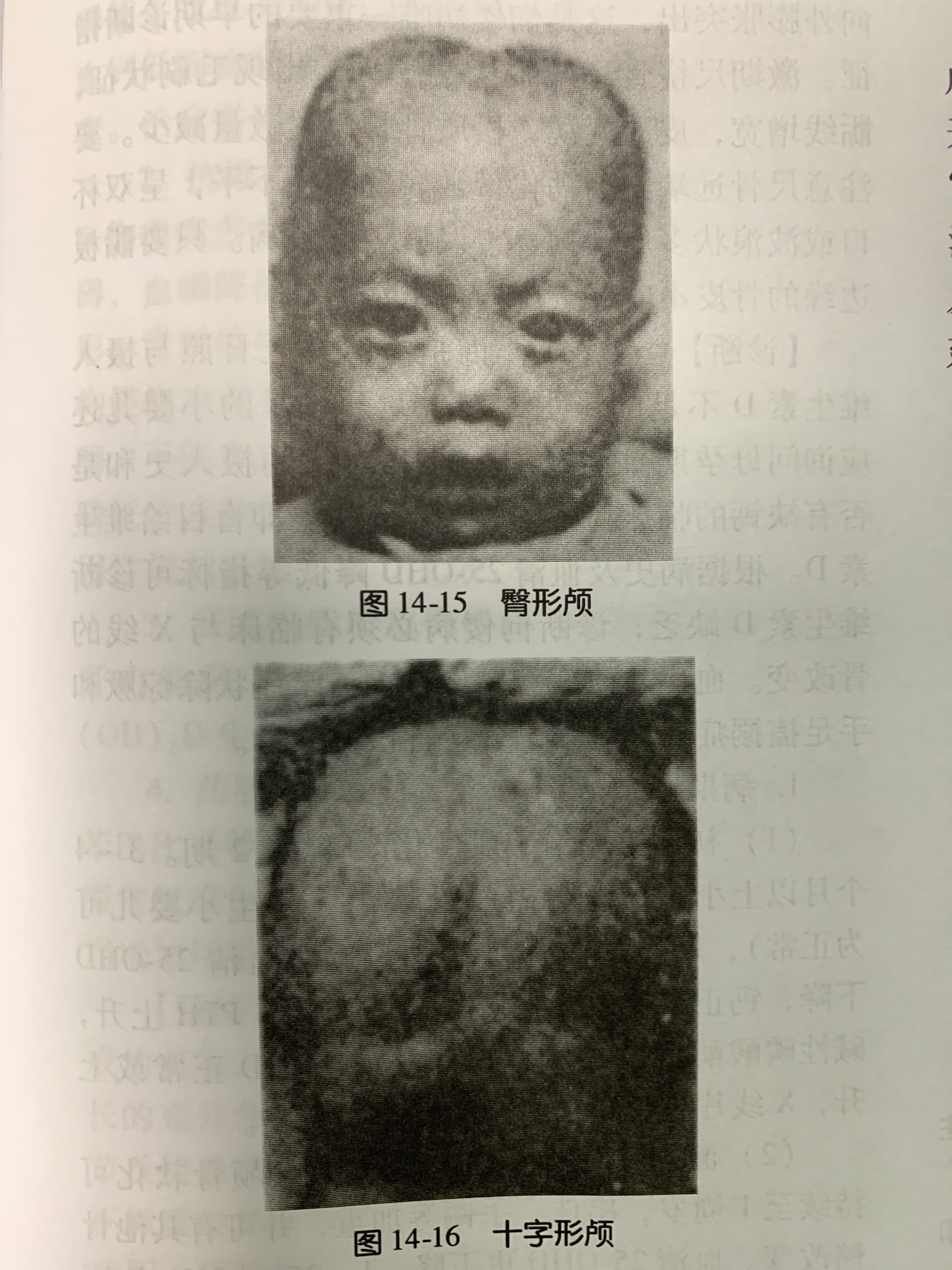 宝宝佝偻病方颅图片图片