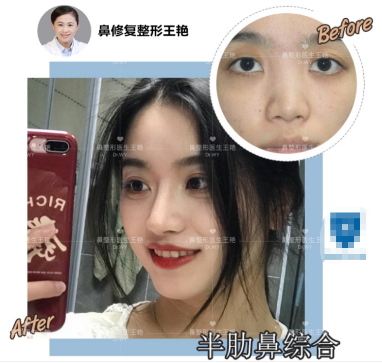 关于鼻修复的一些问题 鼻整形修复 鼻整形修复 关于鼻修复的一些问题 鼻整形修复 鼻整形修复