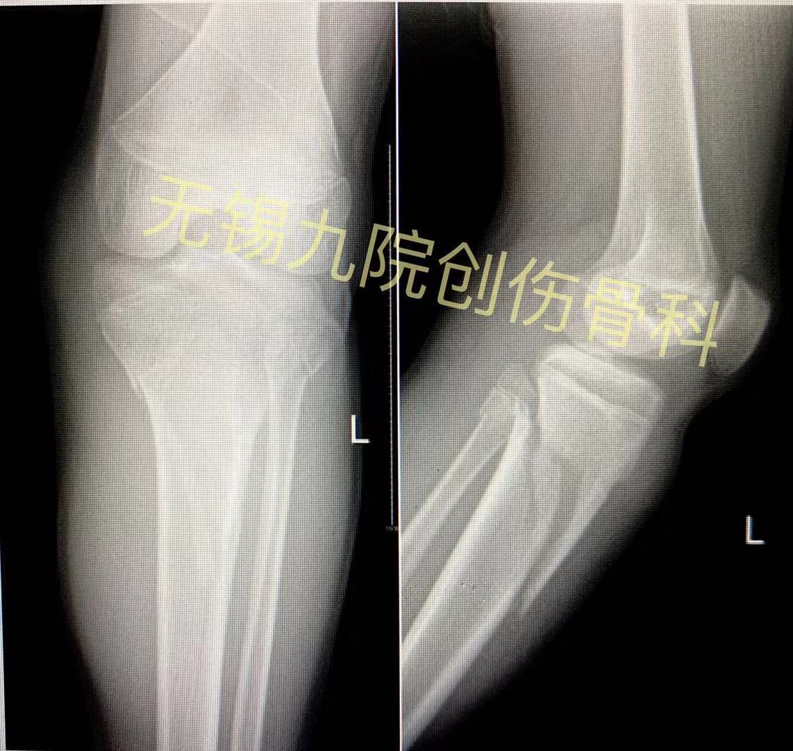 Mipo技术结合钳夹技术微创治疗青少年胫骨近端骨折 胫腓骨骨折 Mipo技术结合钳夹技术微创治疗青少年胫骨近端骨折 胫腓骨骨折