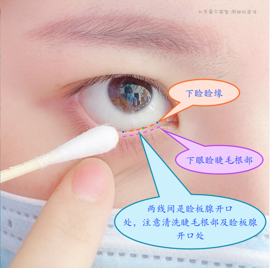 睑缘清洗很重要!_睑缘炎_睑缘炎如何预防 - 好大夫在线