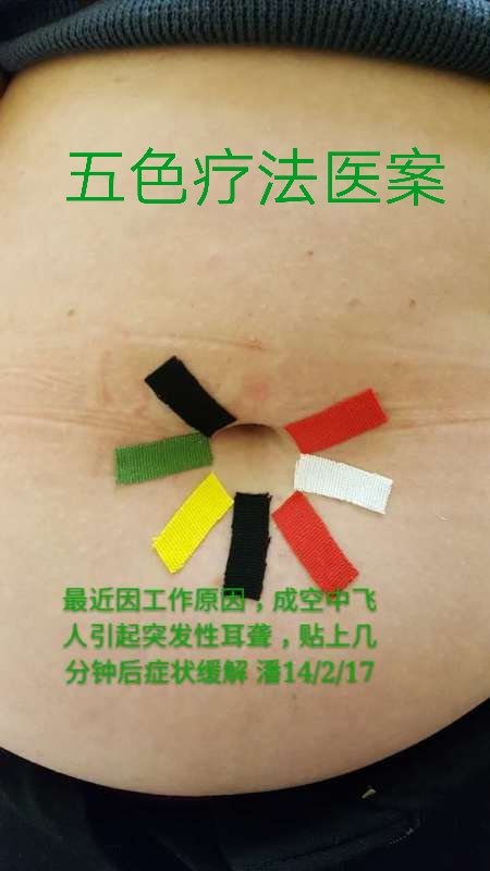 五色疗法治疗乘飞机导致的突发性耳聋 - 好大夫在线
