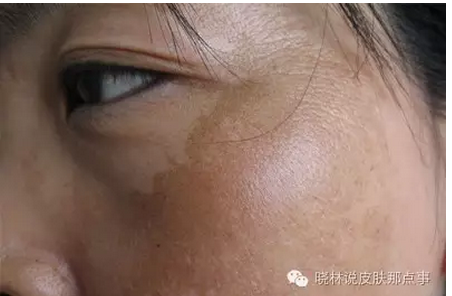 可分布于颧骨部,太阳穴,两颊,额头甚至全脸.