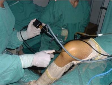 什么是关节镜手术