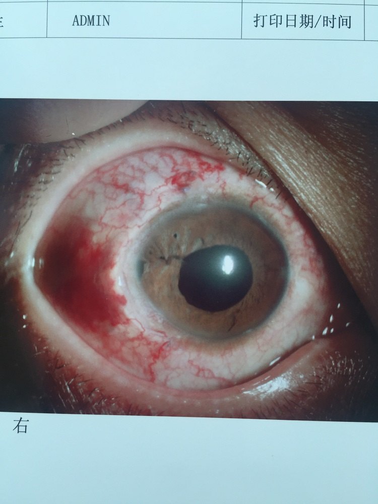虹膜断离/缺损 瞳孔散大修复的病例 - 好大夫在线