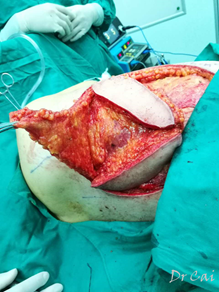 局部晚期乳腺癌的背阔肌kiss皮瓣修复术 - 好大夫在线