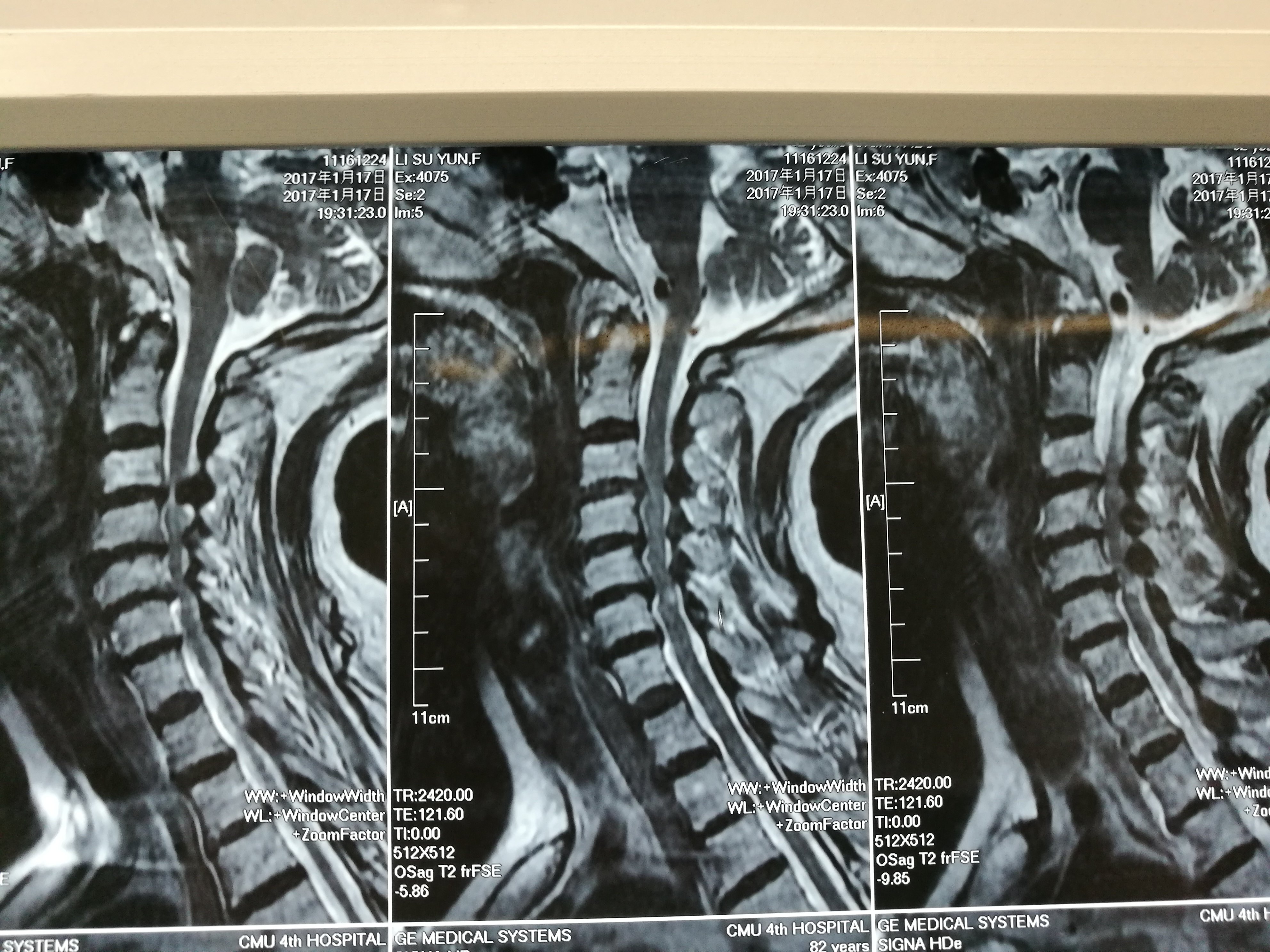 颈椎病,椎管狭窄,黄韧带钙化,神经受压,四肢不全瘫 - 好大夫在线