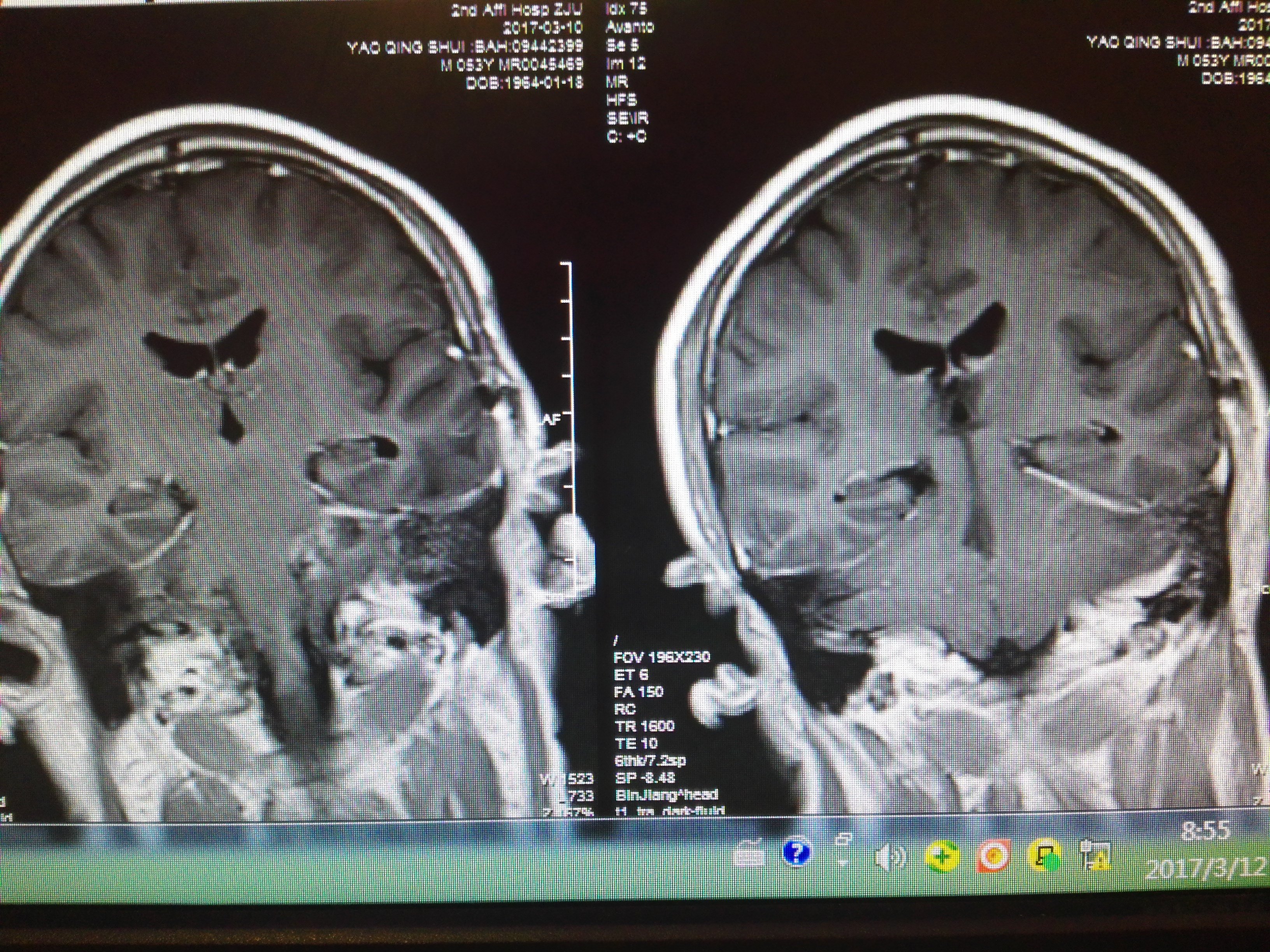 巨大骑跨中后颅窝哑铃型神经鞘瘤全切治疗