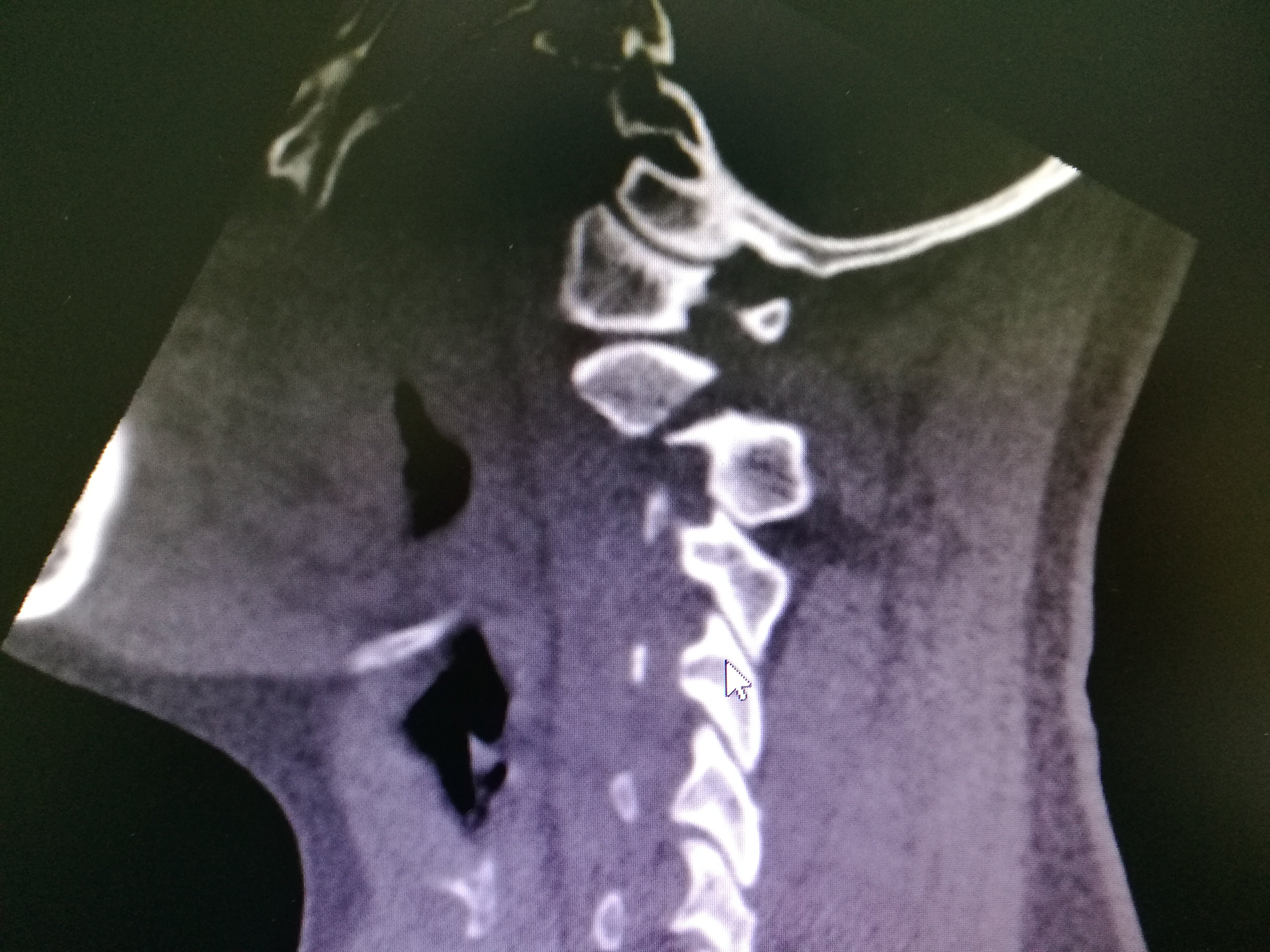 颈椎断裂图片