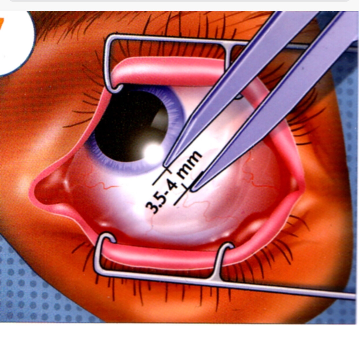 有关玻璃体注药治疗眼底疾病的问题解答 