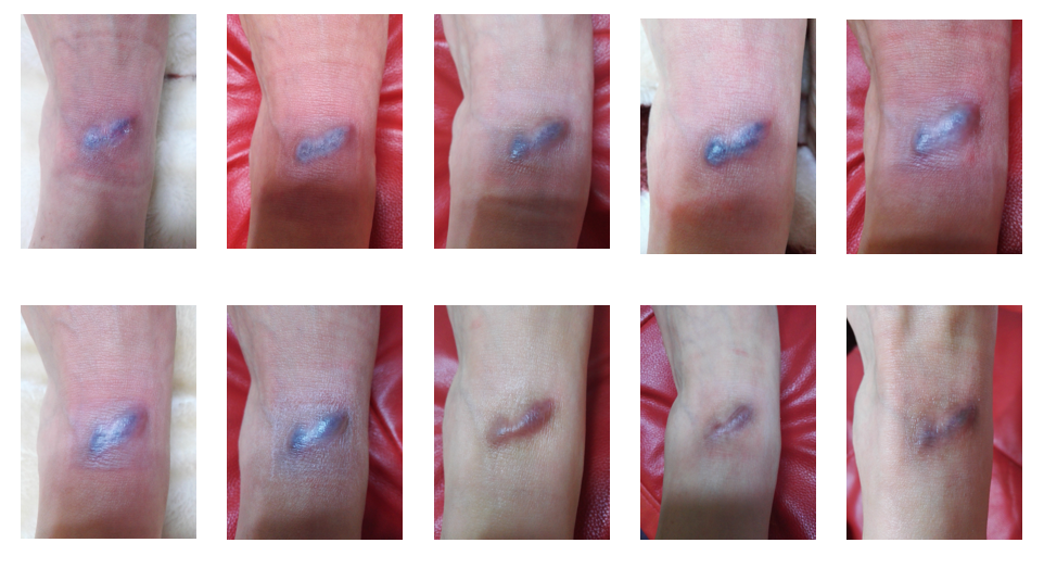 瘢痕(疤痕)增生的治疗方法