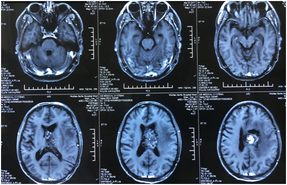 恶性室管膜瘤图片