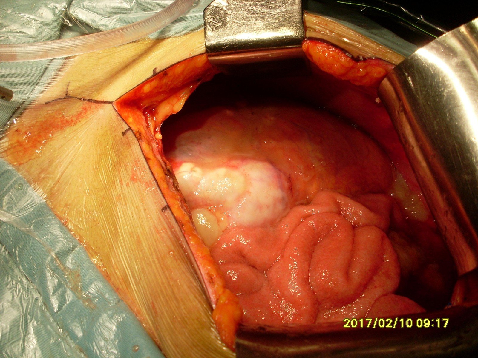 腹膜 粘液瘤图片